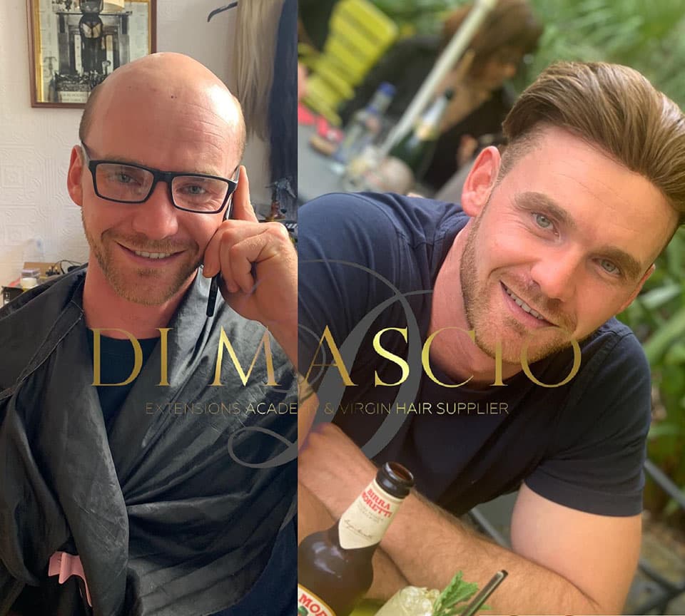 Men's hair replacement before and after transformation