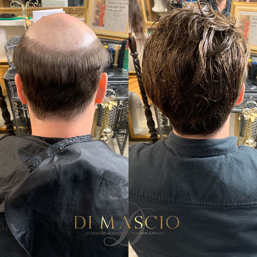 Men's hair replacement before and after transformation